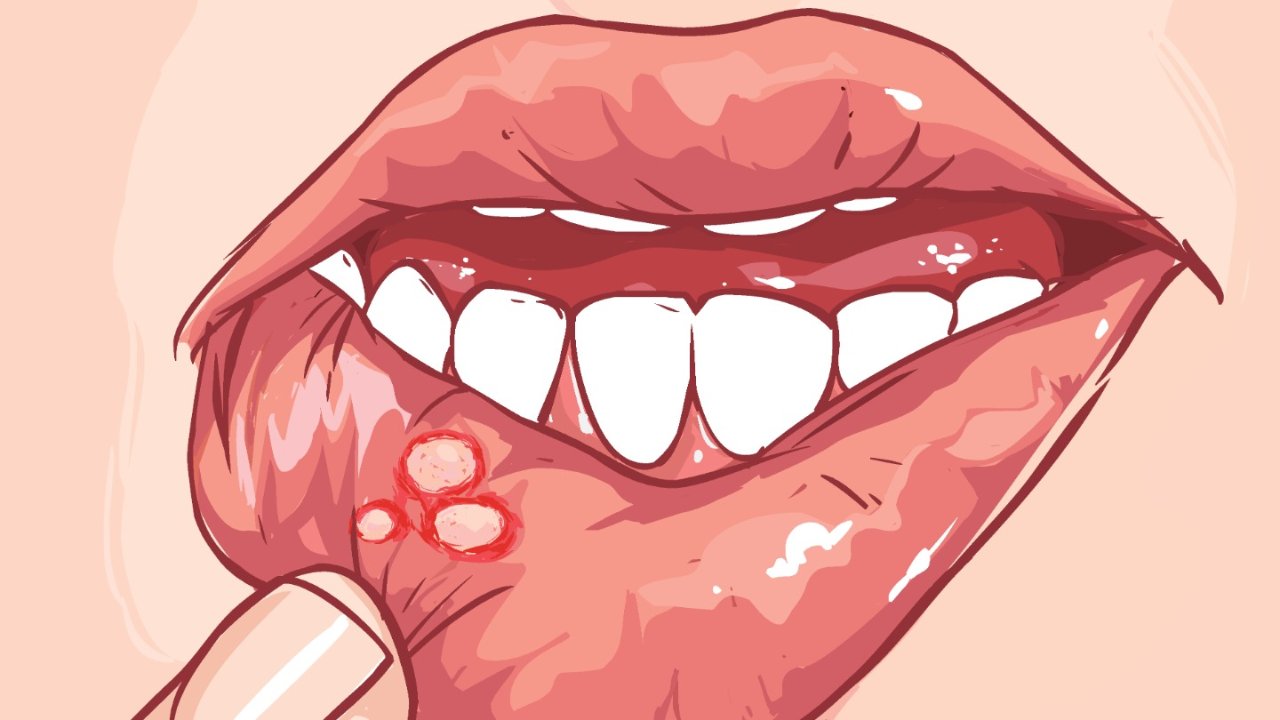 在英国得了口腔溃疡怎么办 | Mouth Ulcers治疗好物推荐！