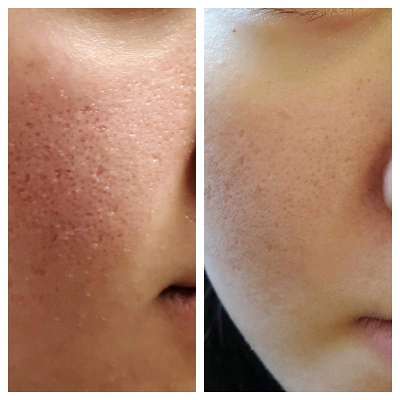 Halo before after